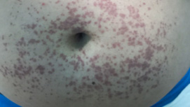 腹型过敏性紫癜