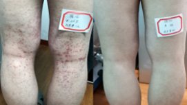 26岁过敏性紫癜患者康复对比