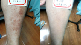 36岁男性色素性紫癜康复对比