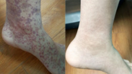 25岁女性紫癜患者康复对比