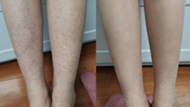 12岁紫癜女孩康复对比