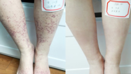 10岁混合型紫癜患者康复对比