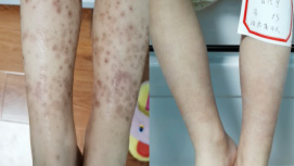 5岁紫癜男孩康复对比