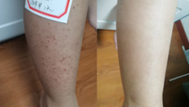 10岁紫癜女孩康复对比