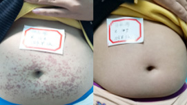 12岁腹型过敏性紫癜康复对比