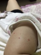 肾型过敏性紫癜如出现少尿情况，需要及时就医检查，以免肾功能损害而不知！