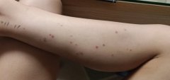 孩子得了过敏性紫癜，该怎么治？