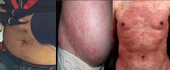 腹型过敏性紫癜患儿的营养如何保障？