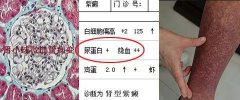 过敏性紫癜患儿回家前，家长应做哪些准备，以减少病情反复几率？