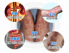 首发症状不见“皮疹”，如何判断自己是否患上过敏性紫癜？
