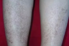 色素性紫癜和过敏性紫癜如何区分？