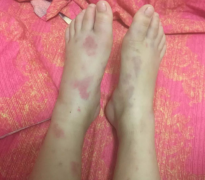 上海紫癜医院：过敏性紫癜的治疗原则
