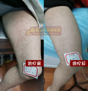 紫癜百科：过敏性紫癜需要检查过敏源吗?过敏性紫癜需要这些检查