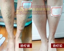 上海紫癜医院分享：治疗过敏性紫癜，牢记这几点