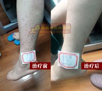 上海紫癜医院分享，治疗紫癜的几条有用建议